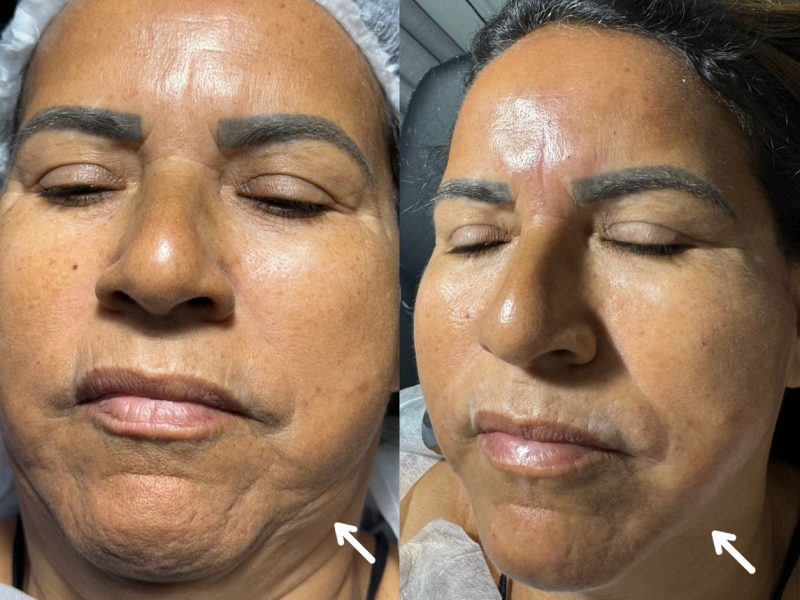 Harmonização facial ou ( correção facial )